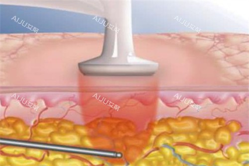 吸脂过程 吸脂过程