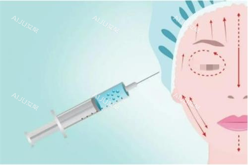 注射玻尿酸示意图 注射玻尿酸示意图