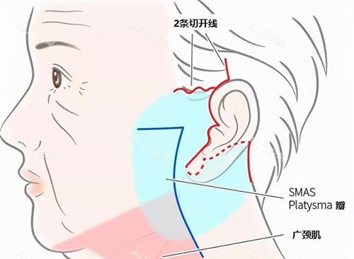 面部拉皮手术 面部拉皮手术