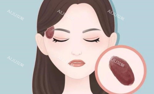 脸上胎记示意图