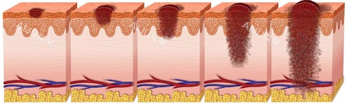 不同深度的疤痕
