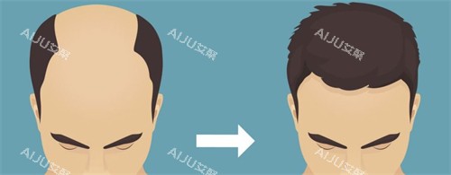 种发际线前后对比