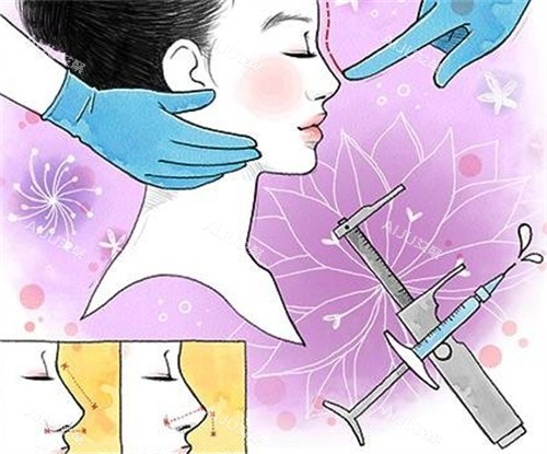 微晶瓷注射隆鼻前后对比