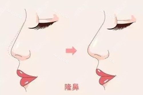 隆鼻对比示意图 隆鼻对比示意图
