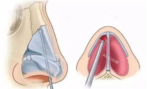 鼻梁鼻尖剖面图 鼻梁鼻尖剖面图