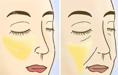 提升手术前后对比 提升手术前后对比