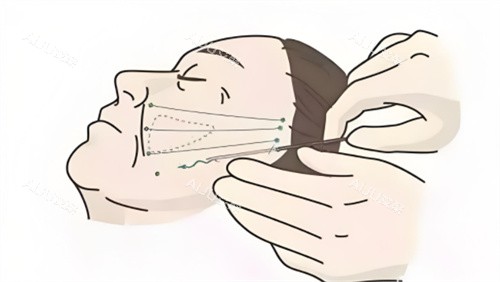 埋线提升图示 埋线提升图示