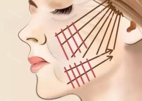 面部埋线提升 面部埋线提升