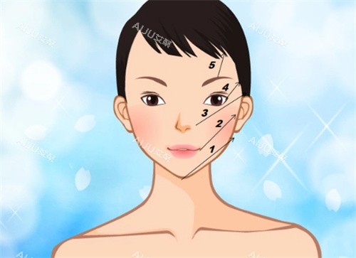 埋线提升 埋线提升