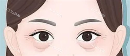 眼袋松弛和泪沟细纹展示图