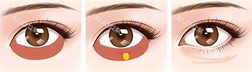 激光祛眼袋术过程 激光祛眼袋术过程