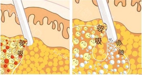 抽脂手术抽脂方式动画演示图 抽脂手术抽脂方式动画演示图