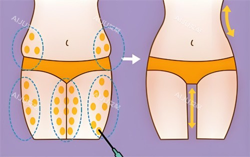 抽脂手术 抽脂手术