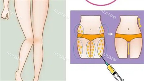 大腿吸脂手术 大腿吸脂手术