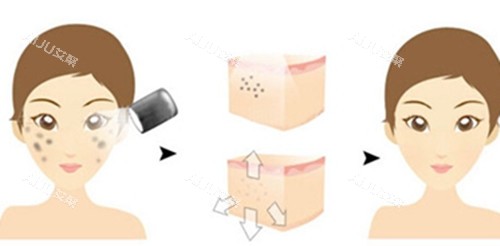 面部激光祛斑前后对比卡通示意图 面部激光祛斑前后对比卡通示意图