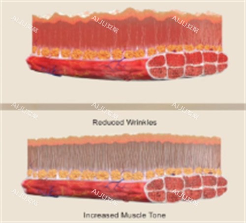 EMFACE美菲斯施术前后对比