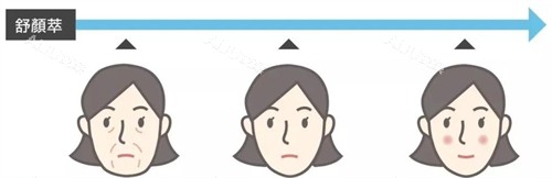 舒颜萃童颜针前后变化 舒颜萃童颜针前后变化