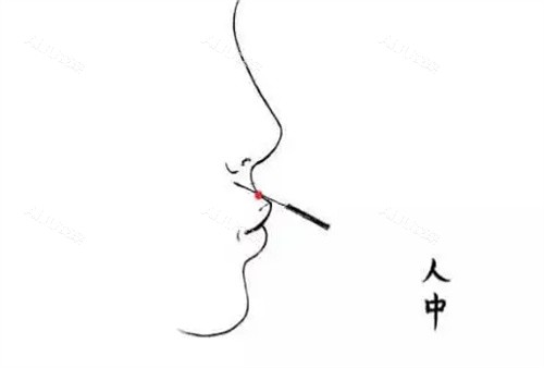 人中加深玻尿酸