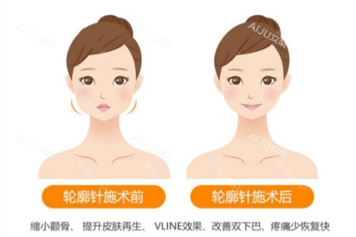 轮廓针卡通对比图