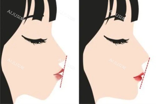 正颌手术前后的对比图 正颌手术前后的对比图