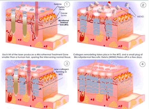 改善皮肤疤痕 改善皮肤疤痕