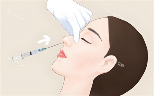 注射隆鼻 注射隆鼻
