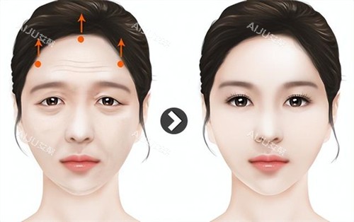 拉皮提眉手术演示动画图