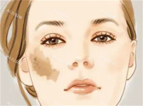 鲜红斑痣的样子 鲜红斑痣的样子