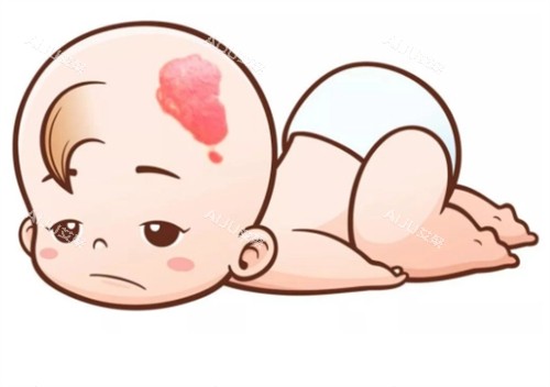 新生儿鲜红斑痣 新生儿鲜红斑痣