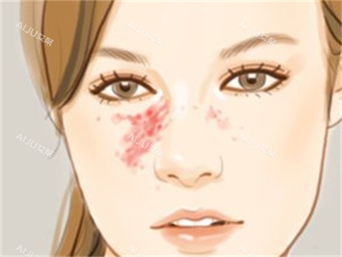 鲜红斑痣图解 鲜红斑痣图解