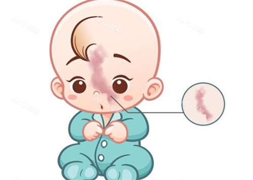 先天鲜红斑痣 先天鲜红斑痣