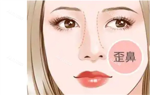 歪鼻修复 歪鼻修复