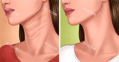 去颈纹前后对比