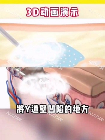 紧缩针注射阴道动画图 紧缩针注射阴道动画图