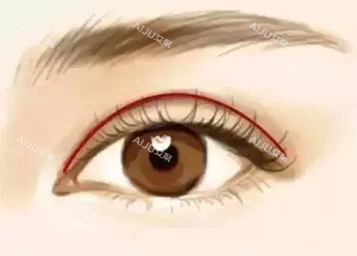 新月形双眼皮.webp 新月形双眼皮.webp