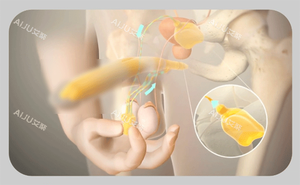 男性阴茎假体植入三件套手术过程