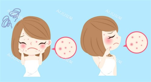 脸上有痘痘 脸上有痘痘