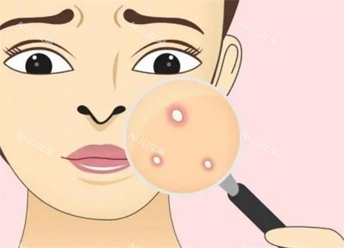痘痘的示意图 痘痘的示意图