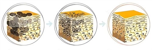 皮秒击碎色斑 皮秒击碎色斑