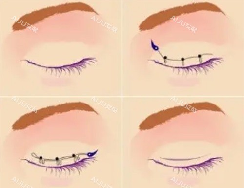 双眼皮手术示意图