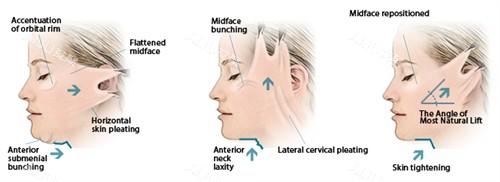 面部提升手术三种提升方向 面部提升手术三种提升方向
