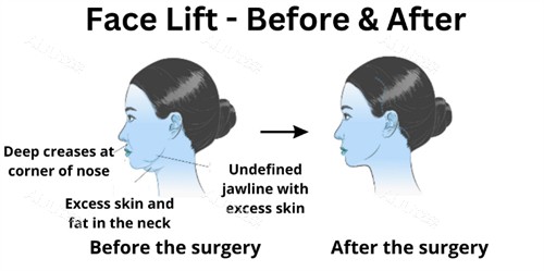 面部提升前后下巴及皮肤的改善对比 面部提升前后下巴及皮肤的改善对比