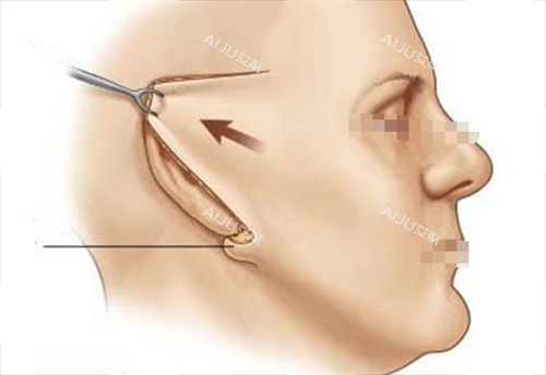 拉皮手术切口展示