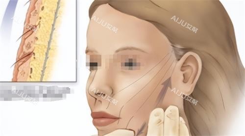 面部青春肽支架提升示意图