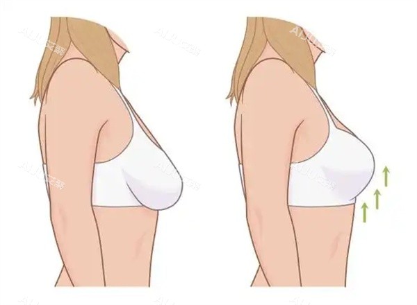 胸部下垂改善 胸部下垂改善