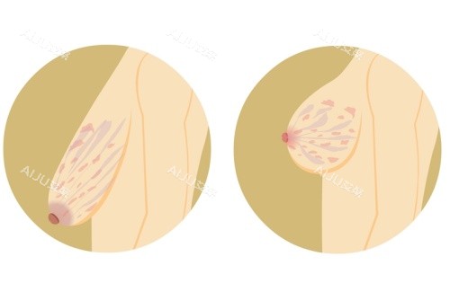 胸部下垂手术前后示意图 胸部下垂手术前后示意图