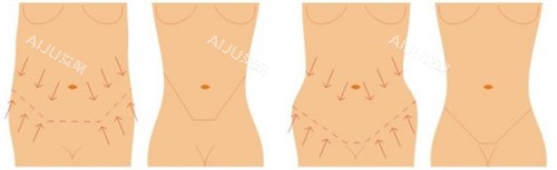 腹壁成形可改善的腰腹状态