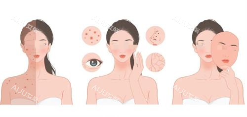 光子嫩肤治疗前后对比图 光子嫩肤治疗前后对比图