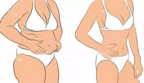 吸脂前后卡通图 吸脂前后卡通图