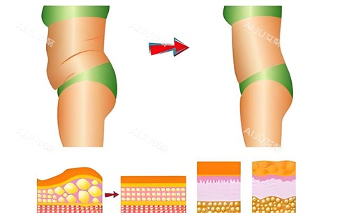 腰腹部吸脂术前后对比动画图 腰腹部吸脂术前后对比动画图
